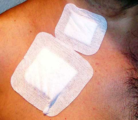 Port-a-Cath