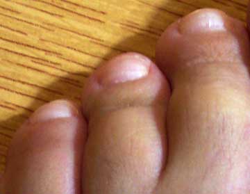 Marcas en las uñas