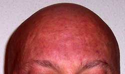 Pelo 12