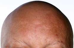 Pelo 11