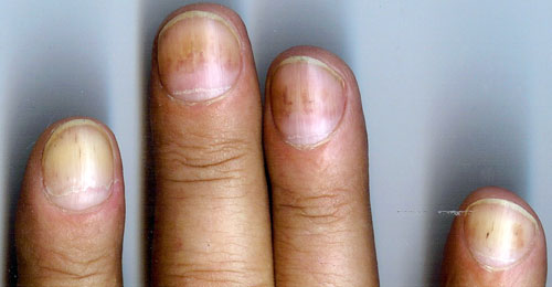 Uñas manchadas