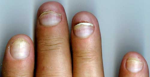 Uñas tras infección